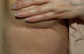 Негативное последствие маммопластики - могут оставаться рубцы