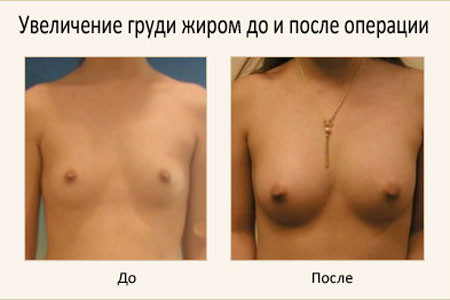Увеличение груди собственными жировыми тканями - до и после